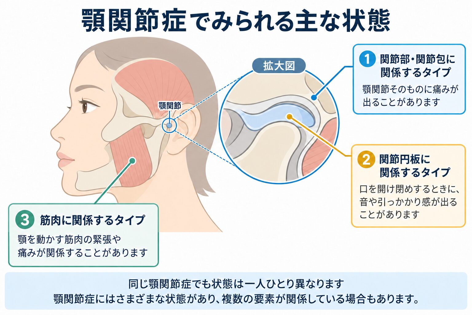 顎関節症でみられる主な状態。関節部・関節包、関節円板、顎を動かす筋肉に関係するタイプを示した模式図。顎関節症にはさまざまな状態があり、複数の要素が関係している場合もあります。